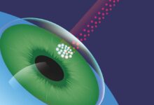 Πώς-αντιμετωπίζεται-το-γλαύκωμα-χωρίς-φάρμακα;